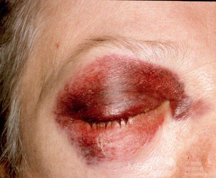 Orbital PreSeptal Hematoma