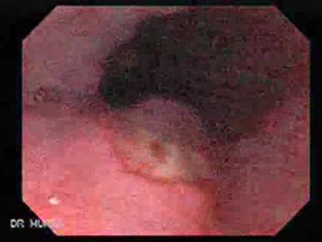 Long Standing Alcohol Abuse - Ulceration Post Ligation