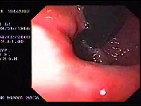 Banding of esophageal varices (17 of 17)