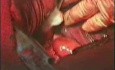 Esophageal Cancer Surgery - Cancer In Lower/3
