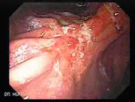 Adenocarcinoma of the Lesser Curvature with Signet Ring Cells (2 of 3) 2