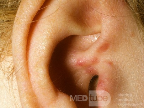 Angiolymphoid Hyperplasia with Eosinophilia [Kimura's Disease]