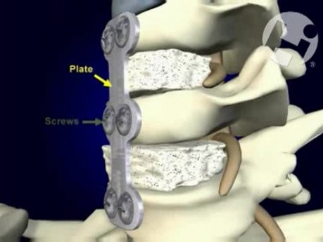Improperly Fitted Bone Graft