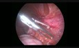 Laparoscopic Adhesiolysis
