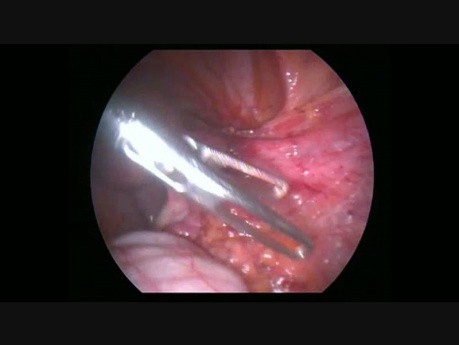 Laparoscopic Adhesiolysis