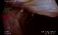 Lower GI Tract Endoscopy