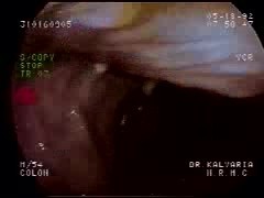 Lower GI Tract Endoscopy