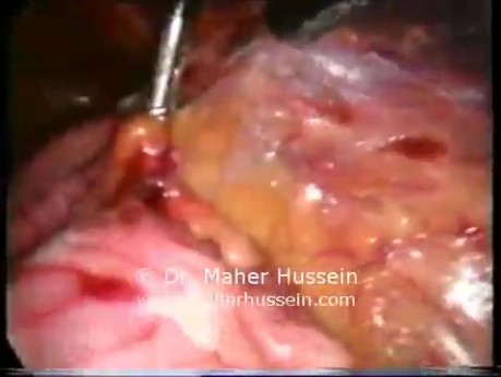 Aorto Caval Lymphnode - Laparoscopic Approach