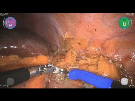 Robotic Left Partial Nephrectomy with Versius - Maurizio De Maria