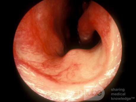 Erectile Tissue on the Floor of the Anterior Nasal Cavity [Right Side]