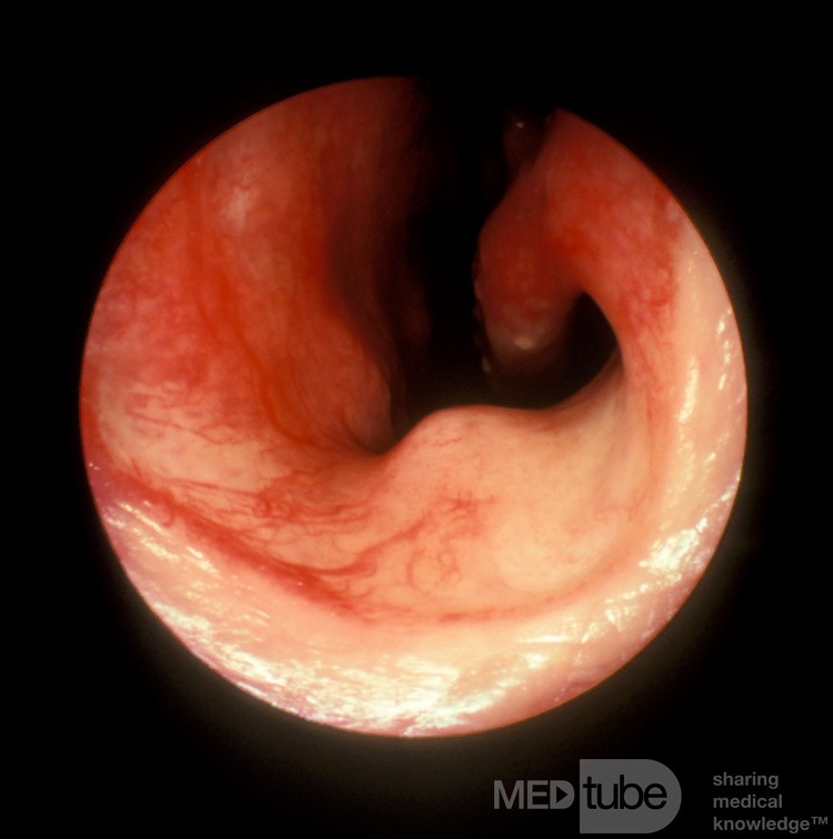 Erectile Tissue on the Floor of the Anterior Nasal Cavity [Right Side]