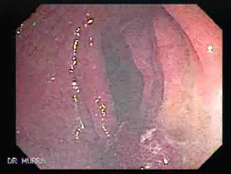 Endoscopic view of Rectal Stalked Polyp (5 of 7)