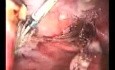 Laparoscopic Supracervical Hysterectomy (LSH)