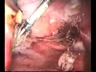 Laparoscopic Supracervical Hysterectomy (LSH)