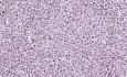 Diffuse large B-cell lymphoma - Histopathology - Lymph node