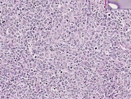 Diffuse large B-cell lymphoma - Histopathology - Lymph node