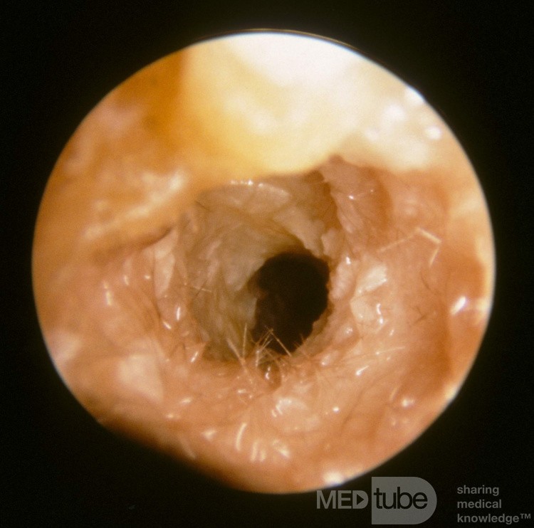 Acute Otitis Media [the stage of resolution]