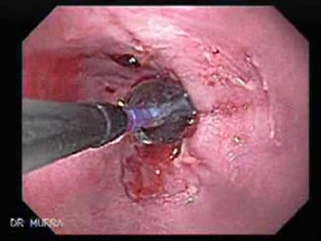 Endoscopic Baloon Dilation Of The Esophageal Stricture - Position Of The Inflated Baloon - 1/8