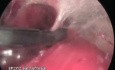 Cruroscopy - Ligation Of Incompetent Perforators