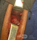 Cloward's Anterior Approach for AO Spine Type C Cervical Fracture with Brown Sequard Syndrome