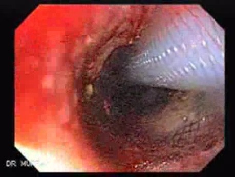 Placement Of The Esophageal Stent - 1/12