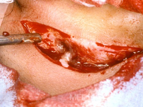 Mastoid Abscess Post Auricular Incision