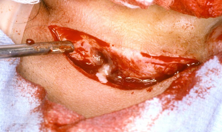 Mastoid Abscess Post Auricular Incision