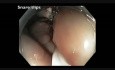 EMR Scar Resection