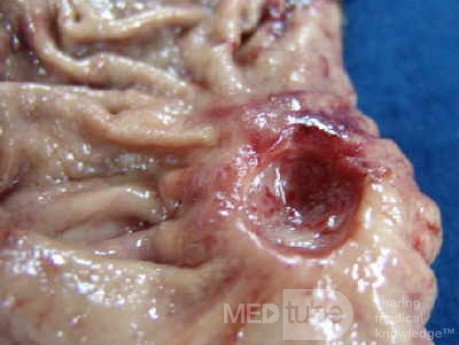 Diffuse Adenocarcinoma with signet ring cells (8 of 18)