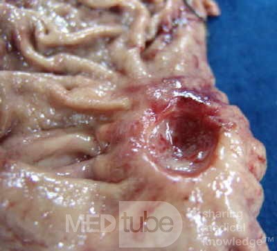 Diffuse Adenocarcinoma with signet ring cells (8 of 18)