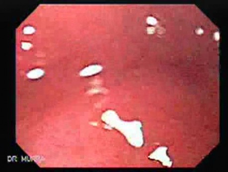 Celiac Disease - Duodenal Mucosa (2 of 5)