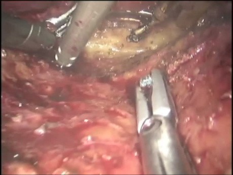 Robotic Abdominoperineal Resection with Distal Sacrectomy