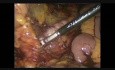 Laparoscopic Total Colectomy with Ileo-Rectal Anastomosis