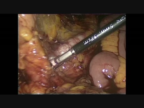Laparoscopic Total Colectomy with Ileo-Rectal Anastomosis