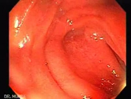Hereditary Hemorrhagic Telangiectasia (Osler-Weber-Rendu syndrome) (1 of 7)