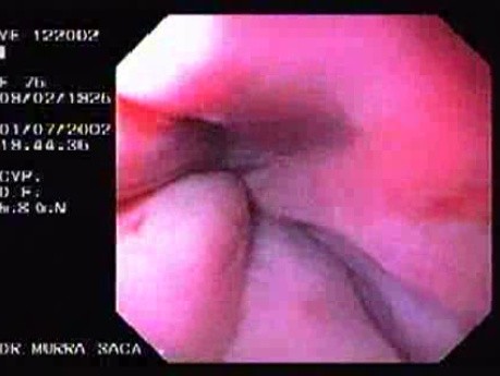 Hemorrhage Due Status Post Rubber Band Ligation of Esophageal Varices - Postoperative Control Image