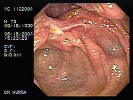 Crohn´s Disease Of The Ileocecal Valve And Terminal Ileum (1 of 5)