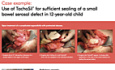 Use of TachoSil® for Sufficient Sealing of a Small Bowel Serosal Defect in 12-Year-Old Child