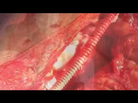 Patient with Extensive Type B Aortic Dissection Undergone Debranching from Zone Zero to SMA and Celiac Axis