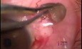 Limbal nodule excision with use of the Fugo Blade