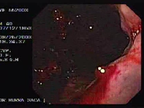 Acute Variceal Bleeding - Source of Bleeding, Part 2