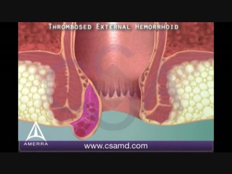 Thrombosed External Hemorrhoid - 3D Medical Animation