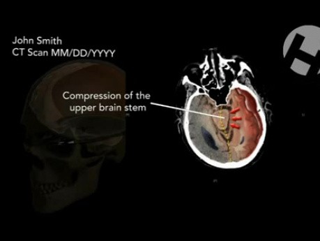 Growth of Subdural Hematoma with Mass Effect