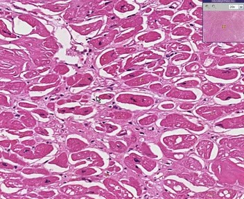 Heart - Amyloidosis
