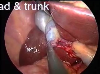 Anatomy of gallbladder during SILS