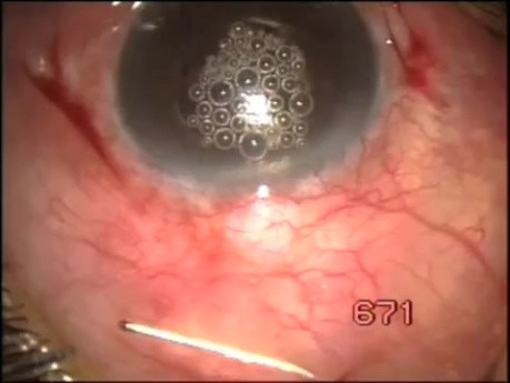 Fugo blade in cyst management