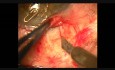 Insertion and fixation technique of Kumar's stainless steel glaucoma device
