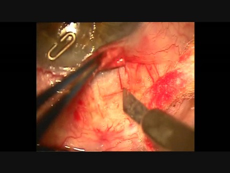 Insertion and fixation technique of Kumar's stainless steel glaucoma device