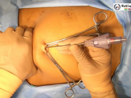 Laparoscopic Repair of Common Bile Duct (CBD) Injury