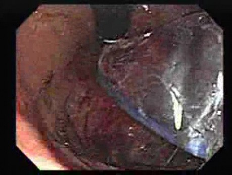 Achalasia - Appearance of the LES After Treatment